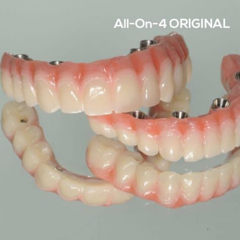 all-on-4-original-stomatološka-poliklinika-breyer-sisak-fiksni-most-al-on-4-sve-na-4-komplet-vilica-najbolji-implantati-garancija-kvaliteta