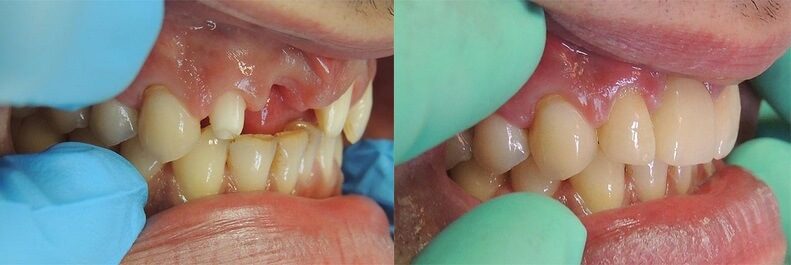 EMAX-keramička-krunica-na-implantatu-dentalna-poliklinika-breyer