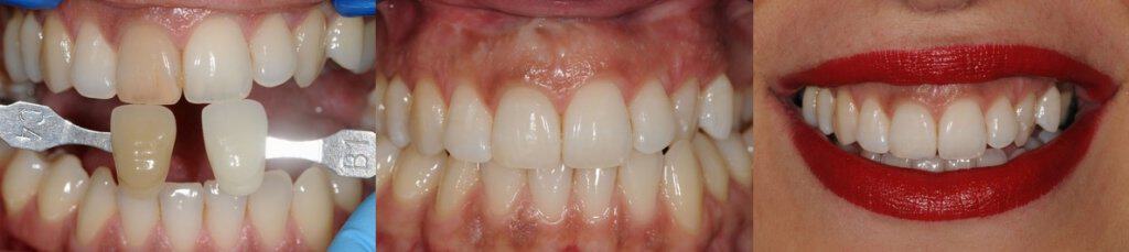 dubinsko-izbjeljivanje-jednog-zuba-dentalna-poliklinika-breyer