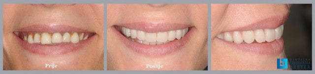 estetska-rekonstrukcija-osmijeha-stomatološka-poliklinika-breyer
