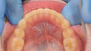 fiksni-retainer-s-unutarnje-strane-zuba-dentalna-poliklinika-breyer