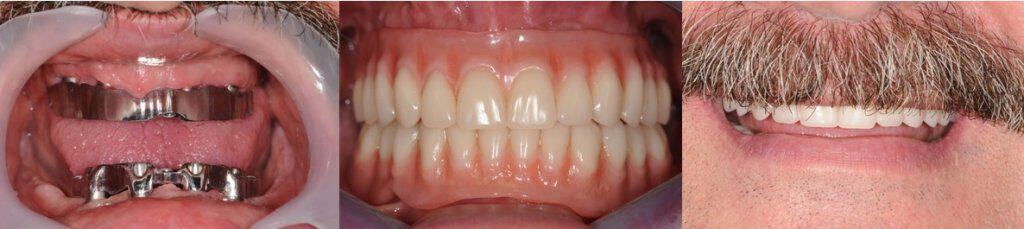 hibridna-proteza-all-on-4-dentalna-poliklinika-breyer