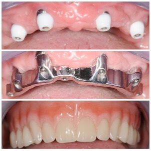 invidualno-frezana-prečka-tri-zglobne-veze-dentalna-poliklinika-breyer