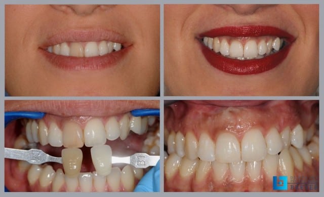 izvanredni-rezultati-endodontskog-izbjeljivanja-zuba-dentalna-poliklinika-breyer