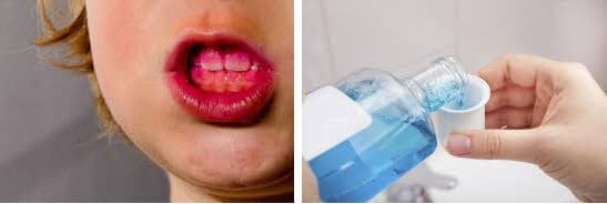korištenje-plak-indikatora-i-vodice-za-ispiranje-usta-karijes-dentalna-poliklinika-breyer