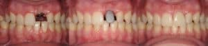 metal-keramička-krunica-na-implantatu-dentalna-poliklinika-breyer
