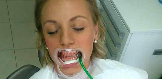 nakon-izbjeljivanja-zuba-gelom-pravi-efekt-vidljiv-nakon-2-tjedna-dentalna-poliklinika-breyer