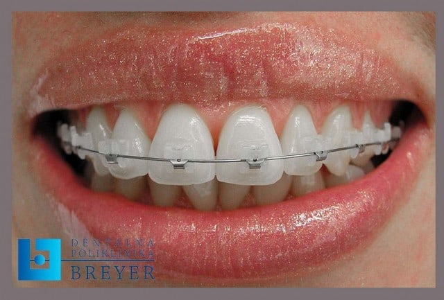 ortodontska-terapija-lijepi-zubi-dentalna-poliklinika-breyer