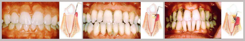 parodontitis-stomatološka-poliklinika-breyer