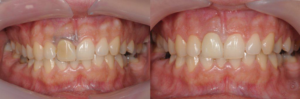 preduga-krunica-zamjenjena-zubno-meso-zaliječeno-dentalna-poliklinika-breyer