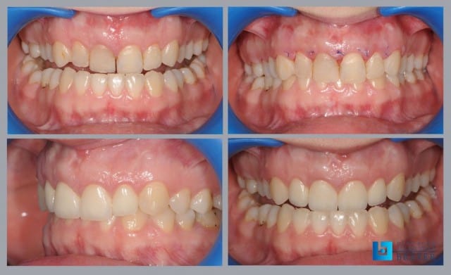 produljenje-krune-zuba-uklanjanjem-viška-zubnog-mesa-stomatološka-poliklinika-breyer
