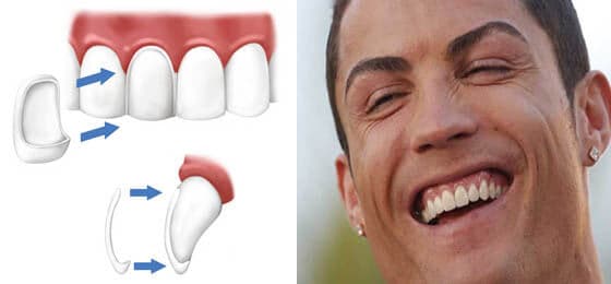 zubne-ljuskice-christiano-ronaldo-dentalna-poliklinika-breyer