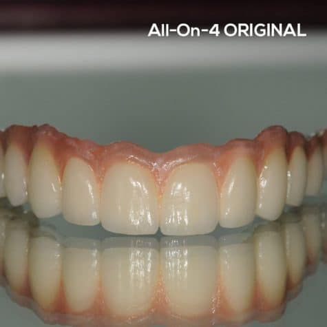 all-on-4-original-stomatološka-poliklinika-breyer-sisak-fiksni-most-al-on-4-sve-na-4-komplet-vilica-najbolji-implantati-garancija-kvaliteta