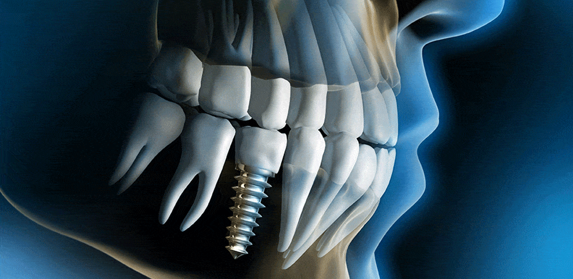 zubar-premium-implantat-cijena-dentalna-poliklinika-breyer-stomatolog-implantati-cijena-hrvatska-zagreb