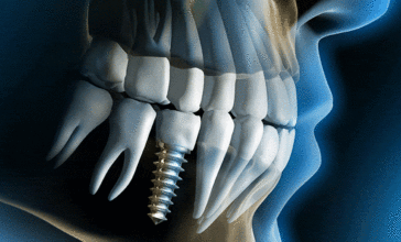 Na svjetskom tržištu postoji više od 1700 proizvođača implantata, dok se u hrvatskim ordinacijama ugrađuje pedesetak različitih brandova. Ipak, među premium implantatima izdvajaju se tri branda koja već pola stoljeća zauzimaju sam vrh: Nobel Biocare, Straumann i Astra Tech.